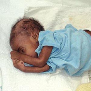 Kwashiorkor, a disease caused by protein deficiency, is prevalent in western Haiti.