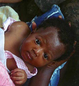This three-month old girl was burning up with fever from an infection in her shoulder. The life-threatening condition required immediate treatment.