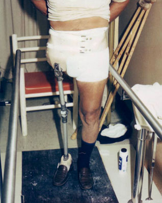 Salvadoran military amputee with a Tinker Toy–like prosthesis in the late 1980s.