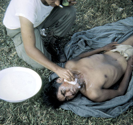After proper treatment of the infection on his face this Ranger served as the senior Bolivian medic in the SF aid station.